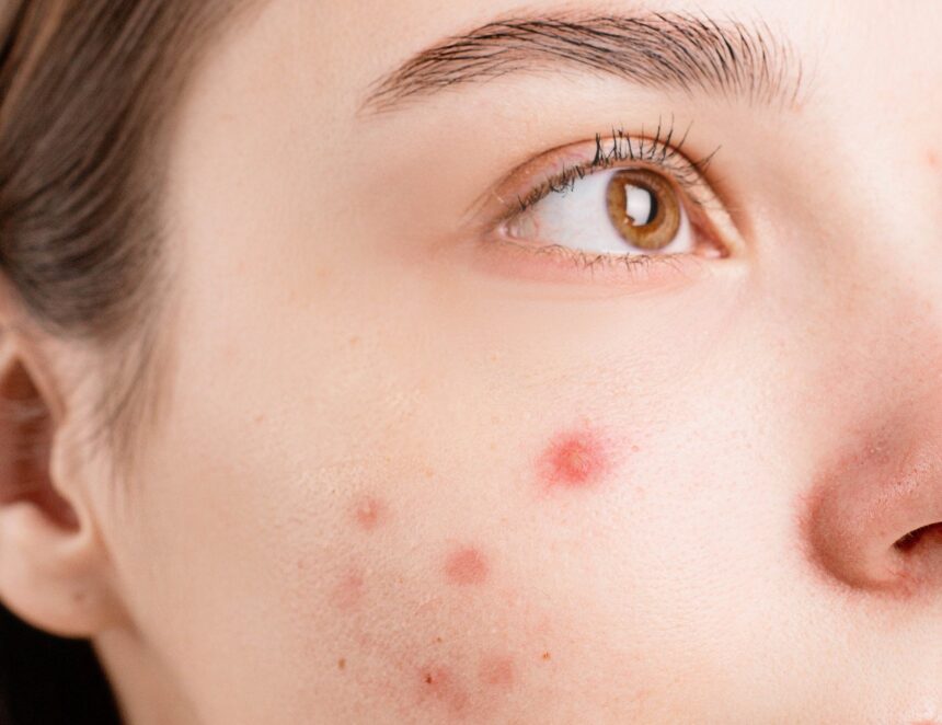 Utilizing Witch Hazel as a natural remedy to combat acne